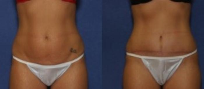 Before & After Tummy Tuck Case 252 Front View in Ypsilanti, MI