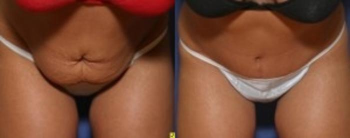 Before & After Tummy Tuck Case 253 Front View in Ann Arbor, MI