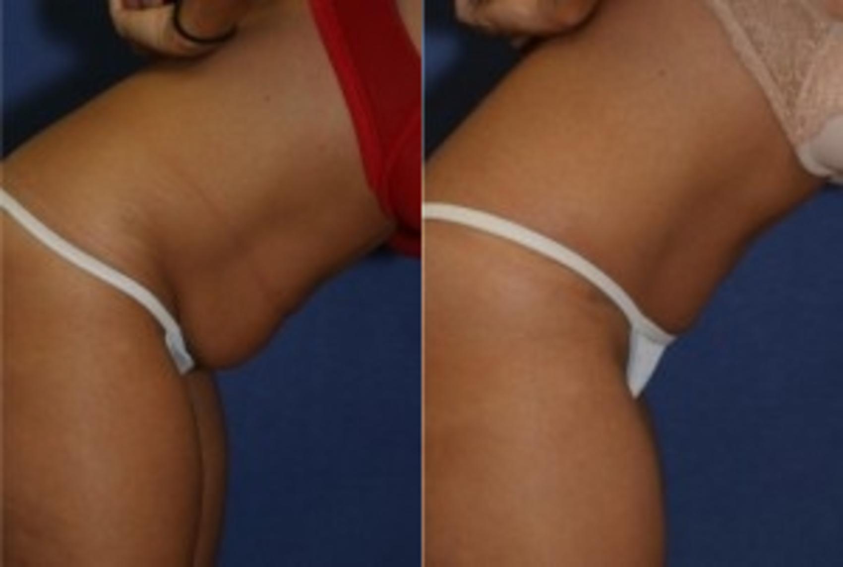 Before & After Tummy Tuck Case 254 Right Side View in Ann Arbor, MI