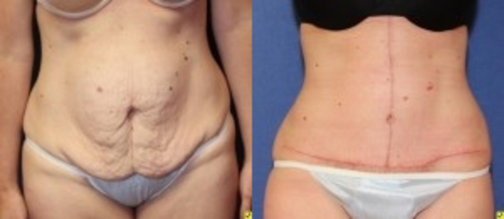 Before & After Tummy Tuck Case 255 Front View in Ann Arbor, MI