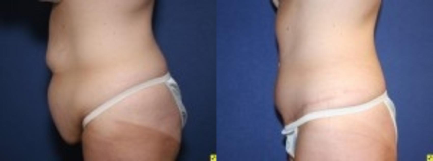 Before & After Tummy Tuck Case 256 Left Side View in Ann Arbor, MI