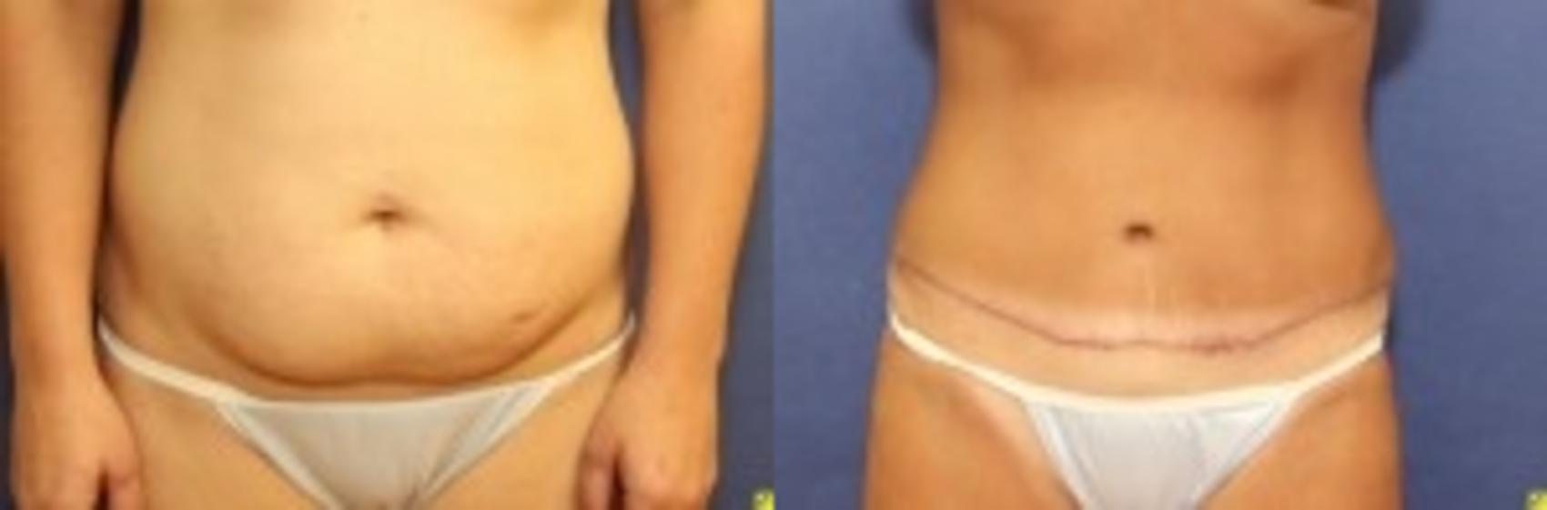 Before & After Tummy Tuck Case 257 Front View in Ann Arbor, MI