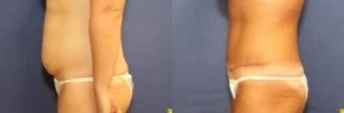 Before & After Tummy Tuck Case 257 Left Side View in Ann Arbor, MI