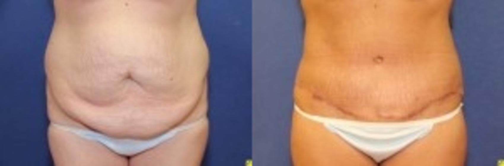Before & After Tummy Tuck Case 258 Front View in Ypsilanti, MI