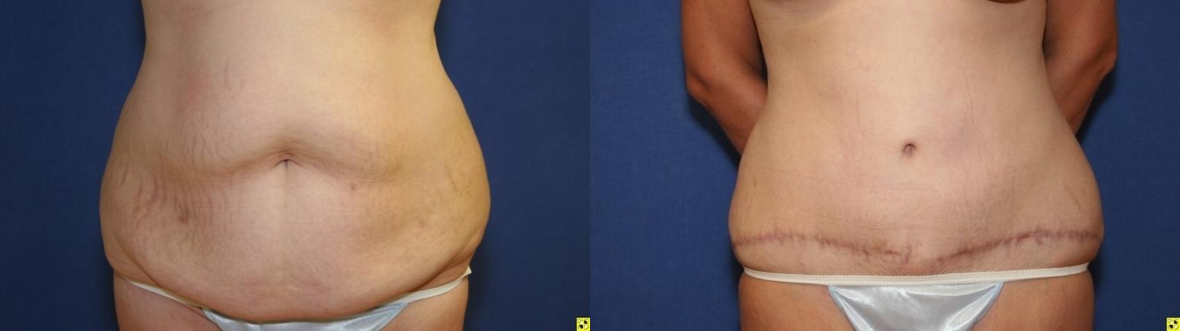 Before & After Tummy Tuck Case 260 Front View in Ann Arbor, MI