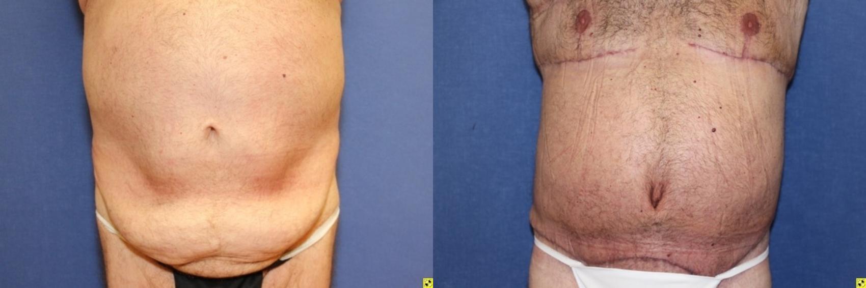 Before & After Tummy Tuck Case 261 Front View in Ann Arbor, MI