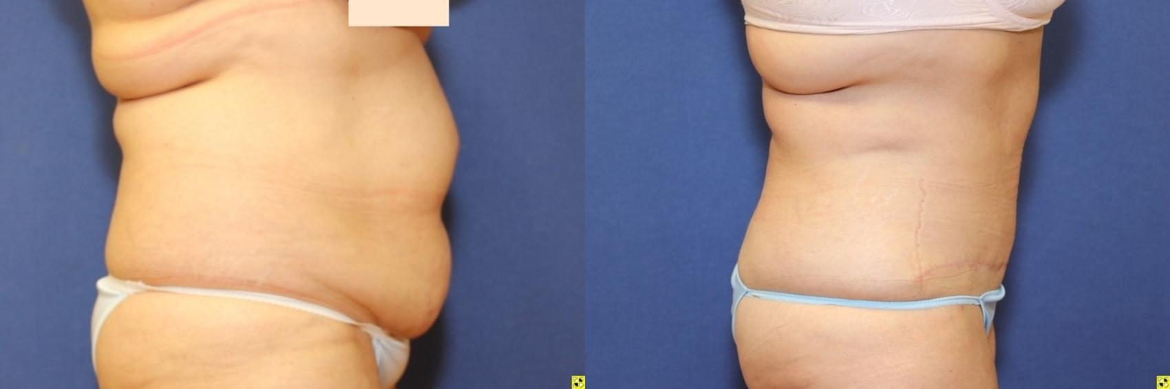Before & After Tummy Tuck Case 262 Right Side View in Ann Arbor, MI
