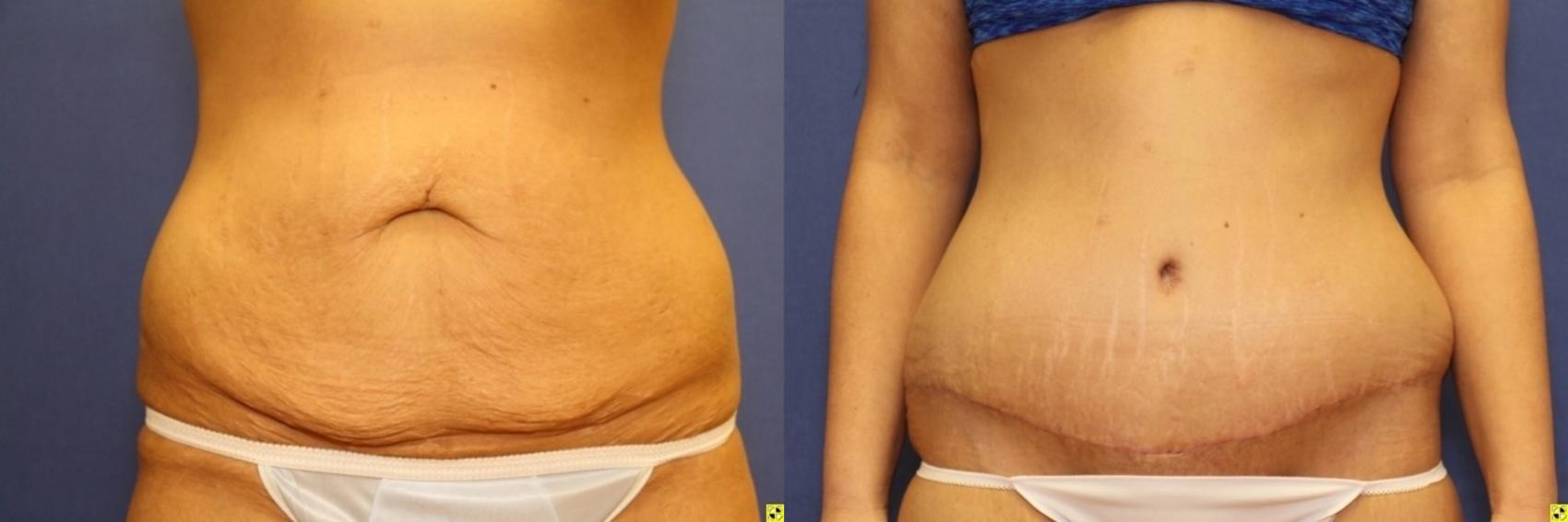 Before & After Tummy Tuck Case 263 Front View in Ann Arbor, MI