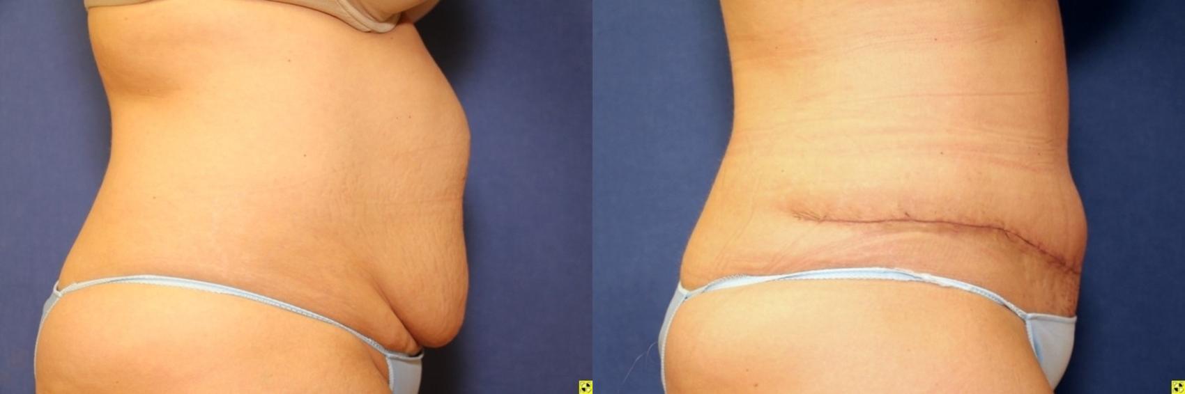 Before & After Tummy Tuck Case 264 Right Side View in Ypsilanti, MI
