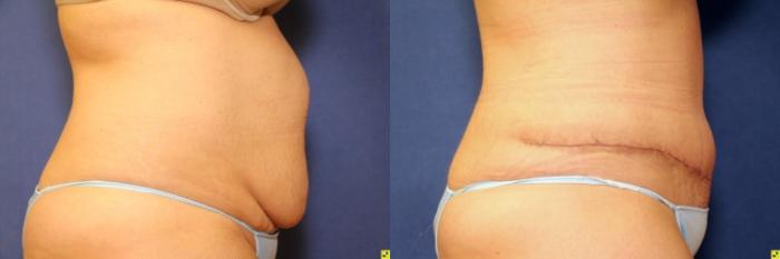 Before & After Tummy Tuck Case 264 Right Side View in Ann Arbor, MI