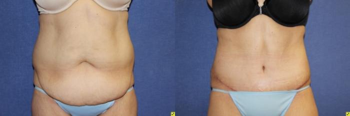 Before & After Tummy Tuck Case 265 Front View in Ann Arbor, MI