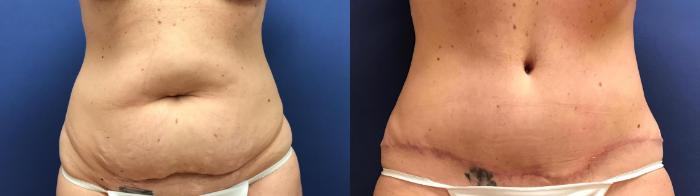 Before & After Tummy Tuck Case 266 Front View in Ann Arbor, MI