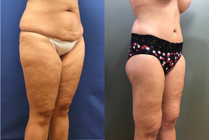 Before & After Tummy Tuck Case 395 Right Side View in Ann Arbor, MI