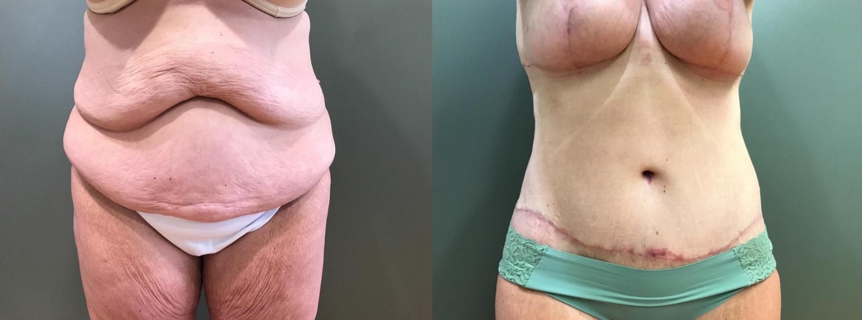 Before & After Tummy Tuck Case 397 Front View in Ypsilanti, MI