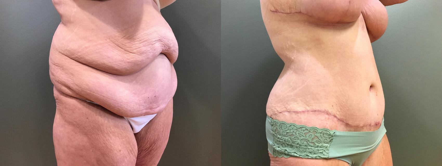 Before & After Tummy Tuck Case 397 Right Side View in Ann Arbor, MI