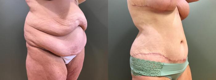 Before & After Tummy Tuck Case 397 Right Side View in Ann Arbor, MI