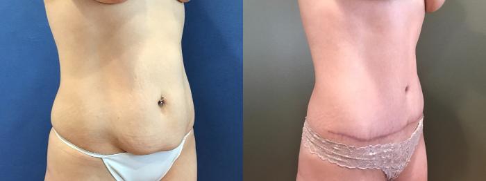 Before & After Tummy Tuck Case 398 Right Side View in Ann Arbor, MI