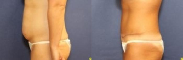 Before & After Tummy Tuck Case 4 Left Side View in Ann Arbor, MI