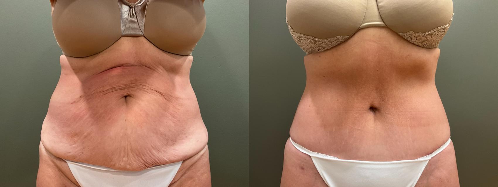 Before & After Tummy Tuck Case 412 Front View in Ann Arbor, MI