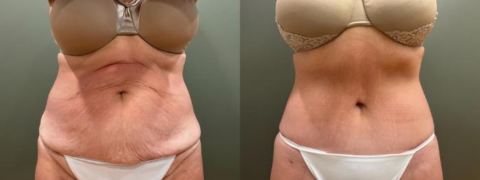 Before & After Tummy Tuck Case 412 Front View in Ann Arbor, MI