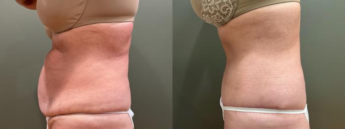 Before & After Tummy Tuck Case 412 Left Side View in Ann Arbor, MI