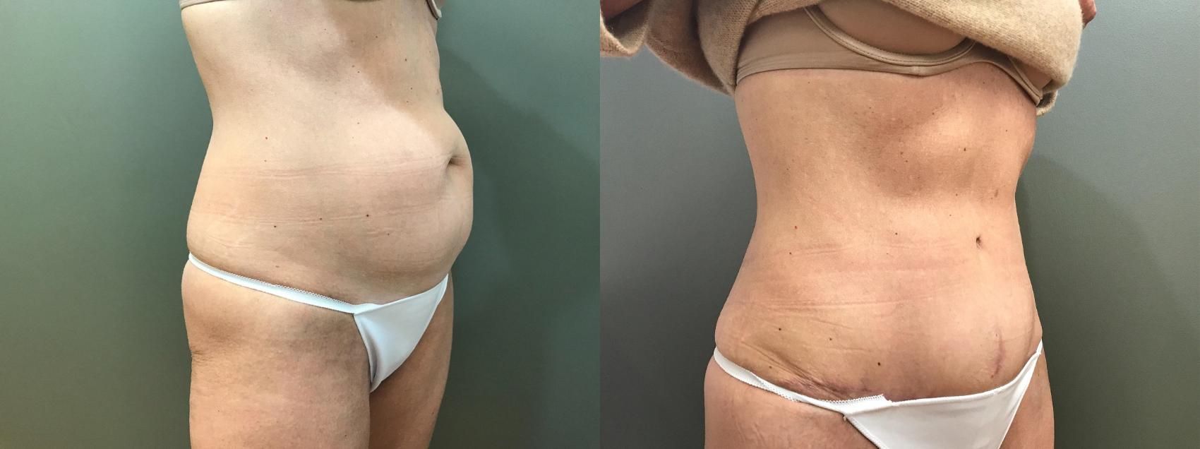 Before & After Tummy Tuck Case 415 Right Oblique View in Ann Arbor, MI