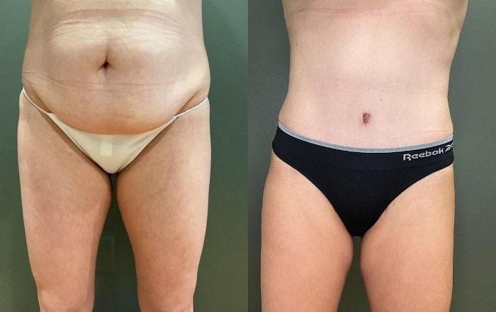 Before & After Tummy Tuck Case 425 Front View in Ann Arbor, MI