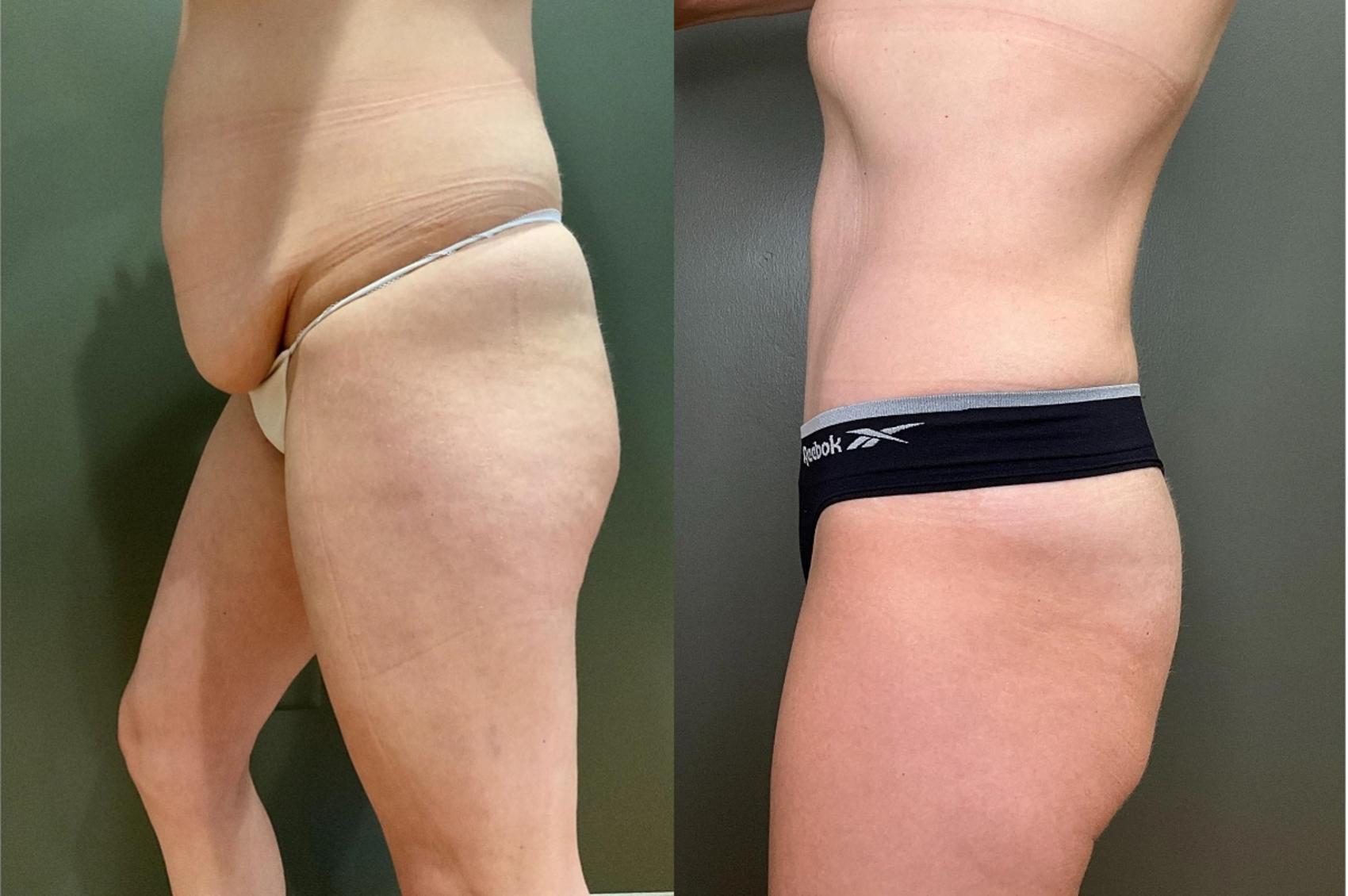 Before & After Tummy Tuck Case 425 Left Side View in Ann Arbor, MI