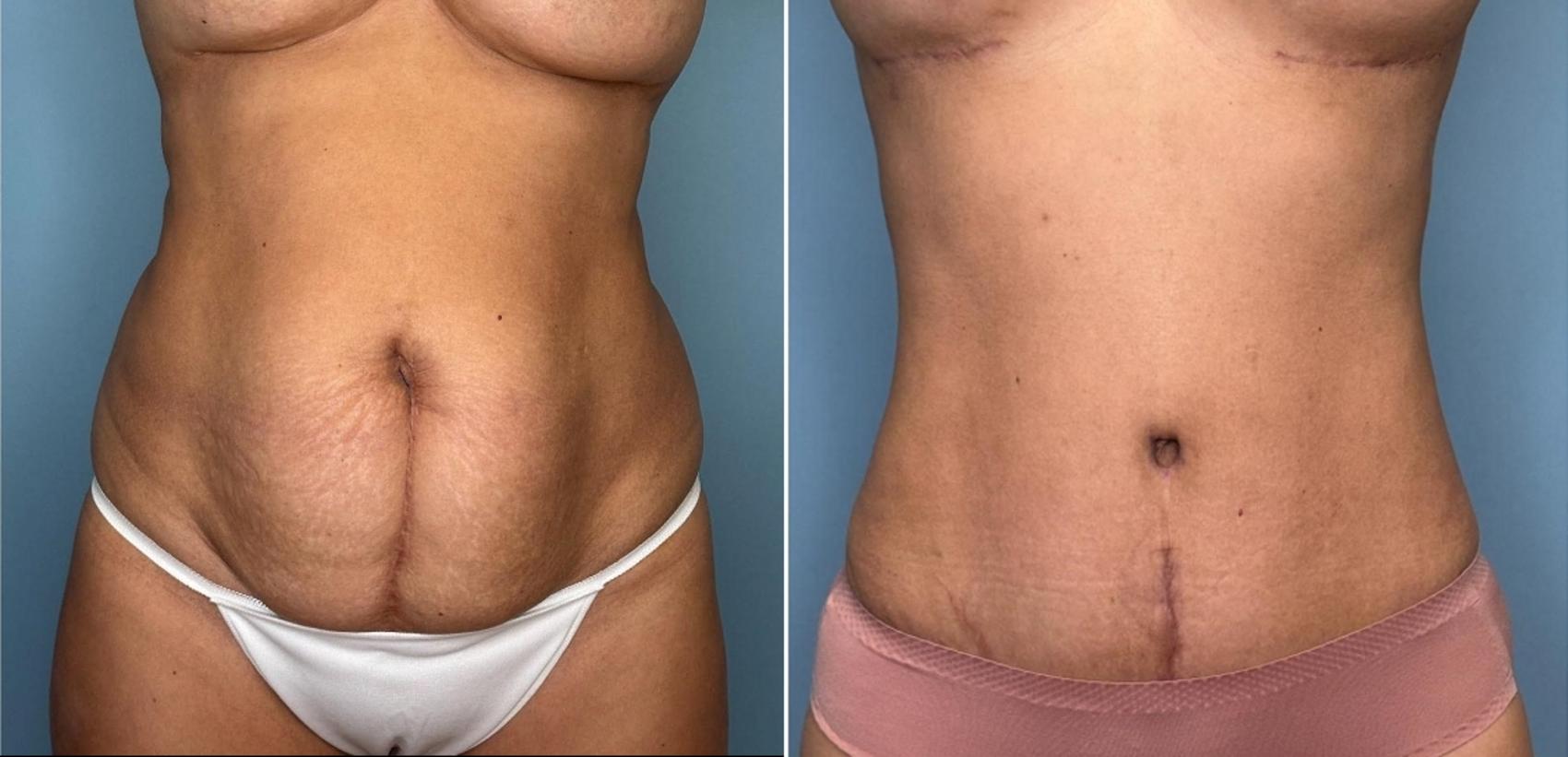 Before & After Tummy Tuck Case 434 Front View in Ann Arbor, MI