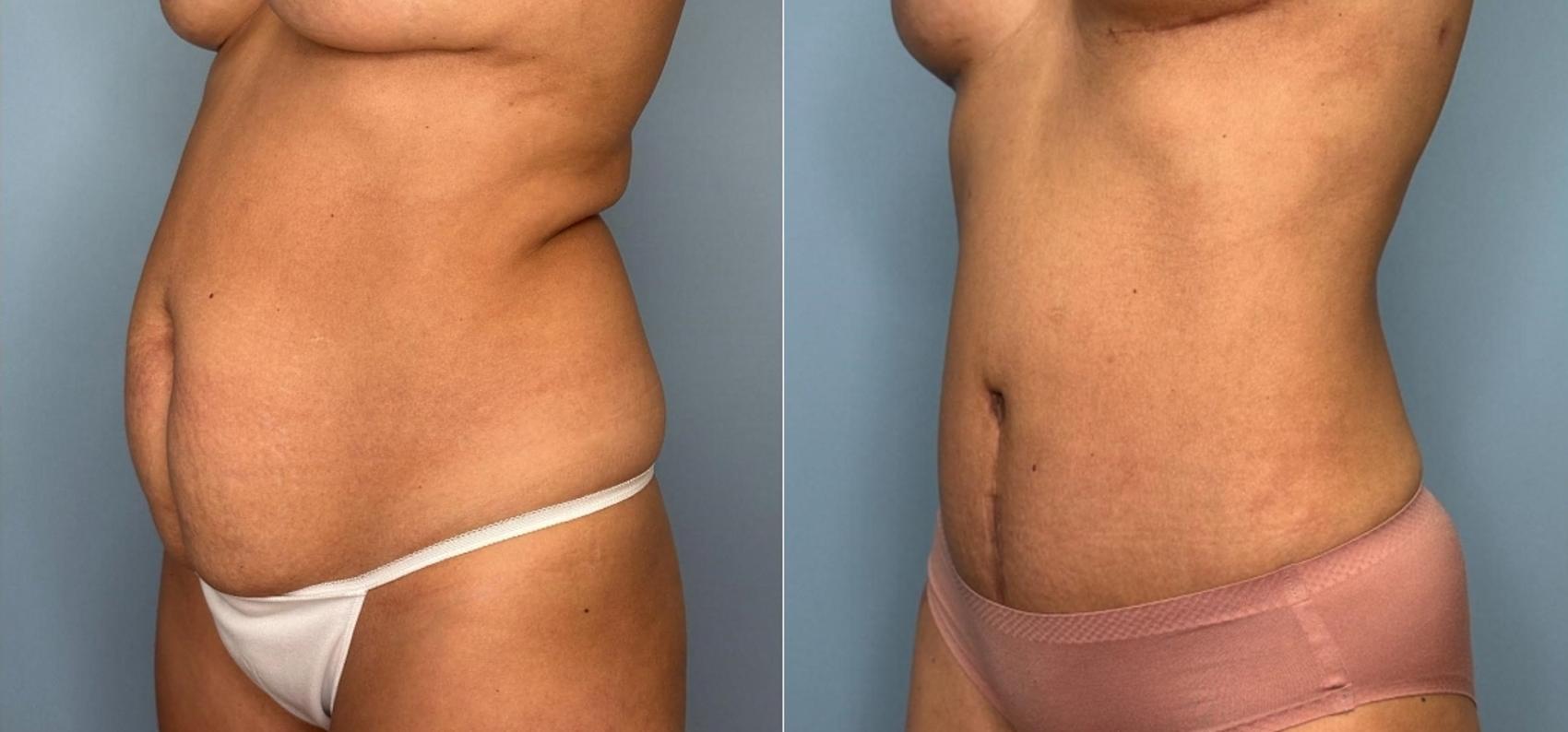 Before & After Tummy Tuck Case 434 Left Oblique View in Ann Arbor, MI