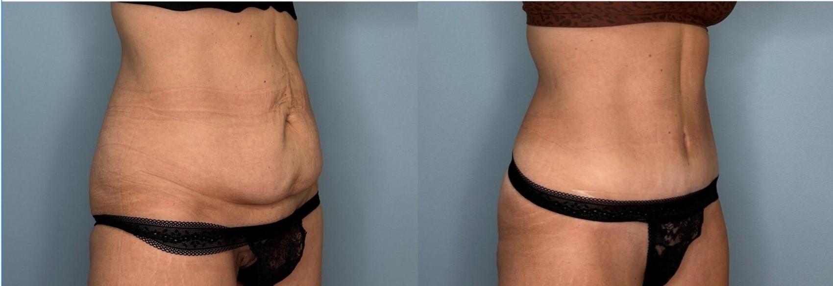 Before & After Tummy Tuck Case 435 Right Oblique View in Ann Arbor, MI