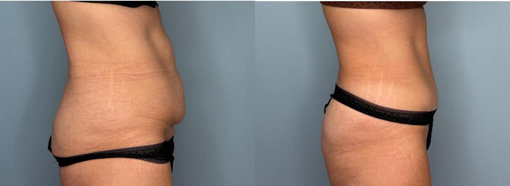 Before & After Tummy Tuck Case 435 Right Side View in Ann Arbor, MI