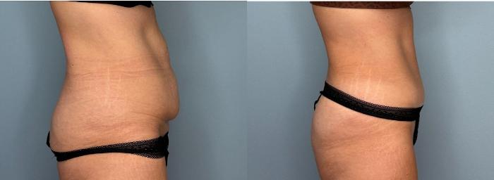 Before & After Tummy Tuck Case 435 Right Side View in Ann Arbor, MI