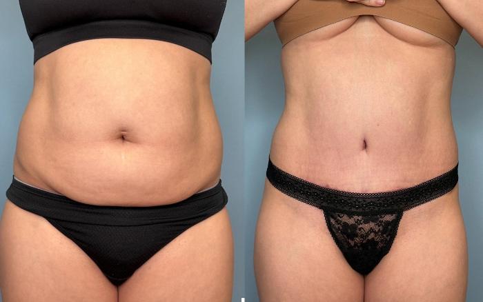 Before & After Tummy Tuck Case 436 Front View in Ann Arbor, MI