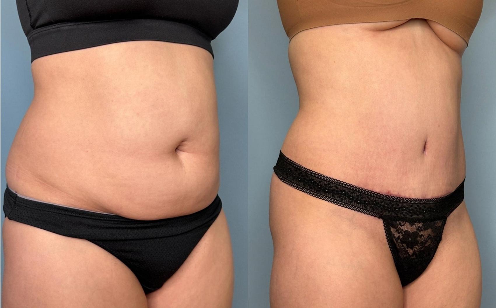 Before & After Tummy Tuck Case 436 Right Oblique View in Ann Arbor, MI