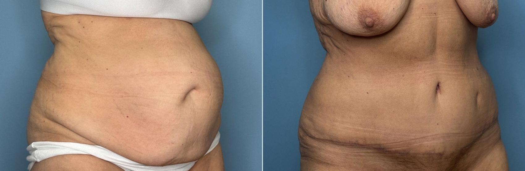 Before & After Tummy Tuck Case 442 Right Oblique View in Ann Arbor, MI