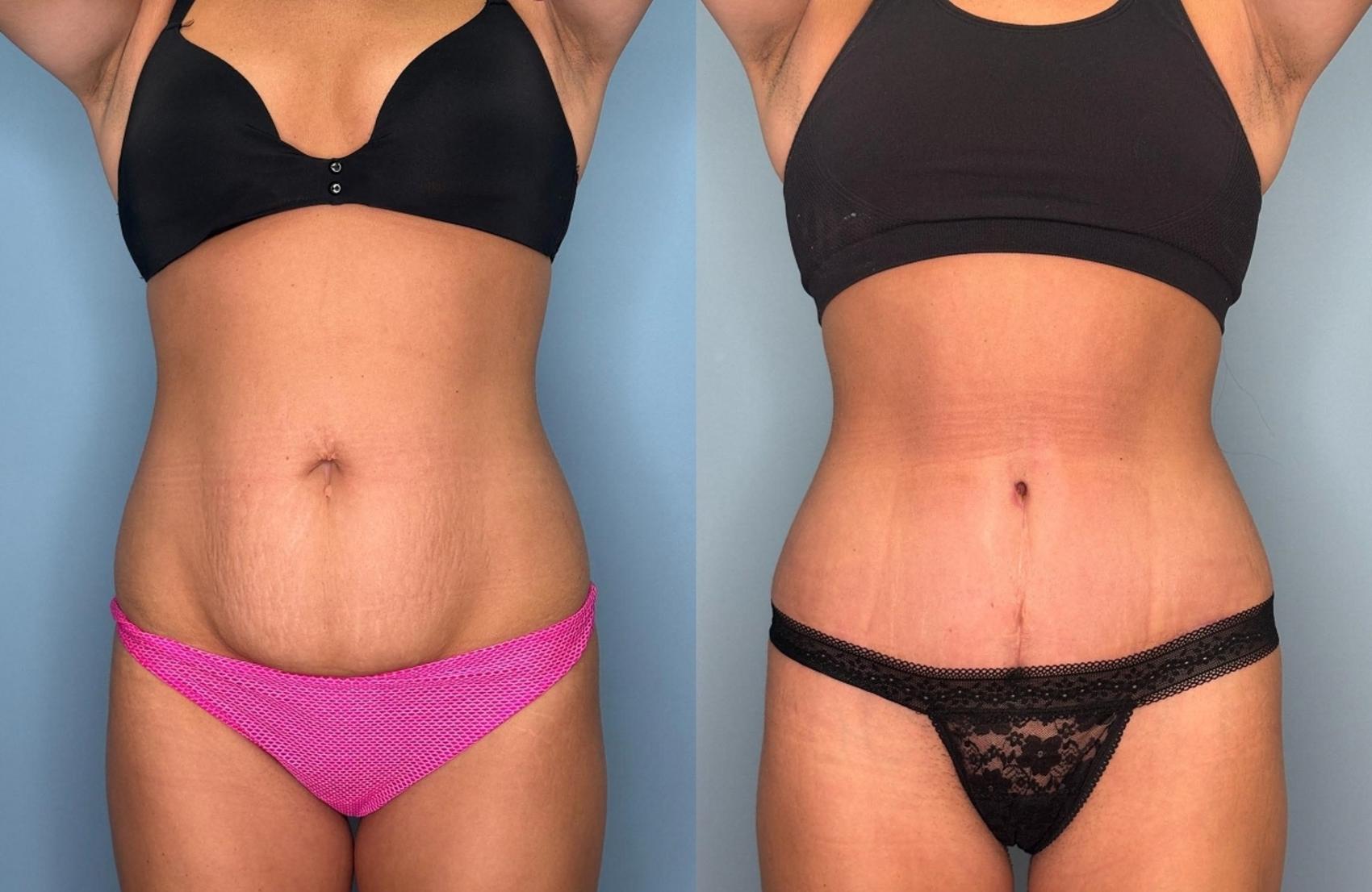 Before & After Tummy Tuck Case 449 Front View in Ann Arbor, MI