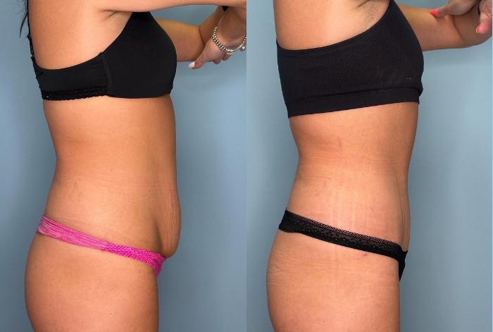 Before & After Tummy Tuck Case 449 Right Side View in Ann Arbor, MI