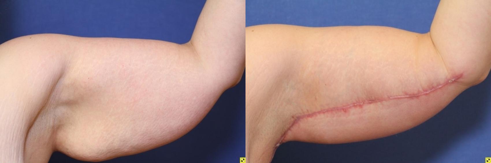 Before & After Upper Arm Lift Case 271 Front View in Ypsilanti, MI