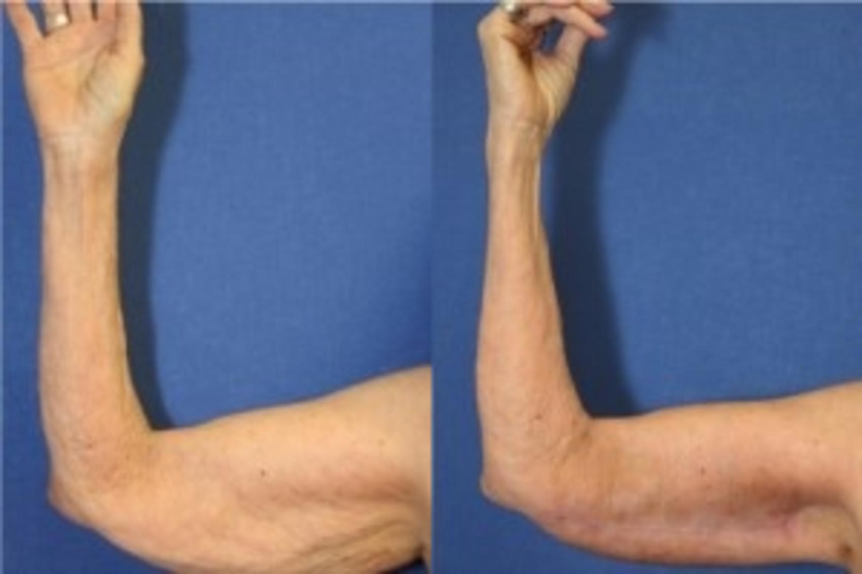Before & After Upper Arm Lift Case 272 Front View in Ypsilanti, MI