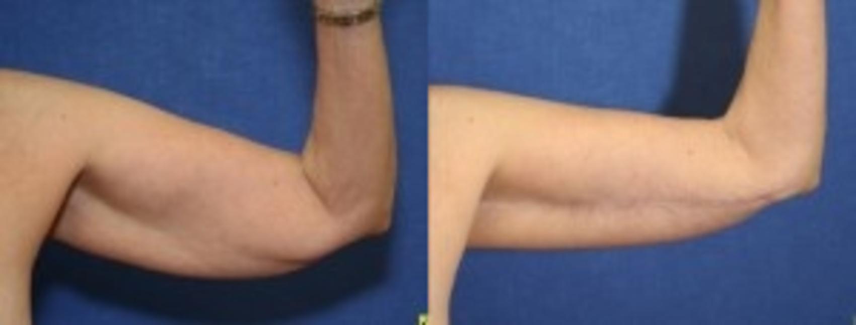 Before & After Upper Arm Lift Case 273 Front View in Ypsilanti, MI