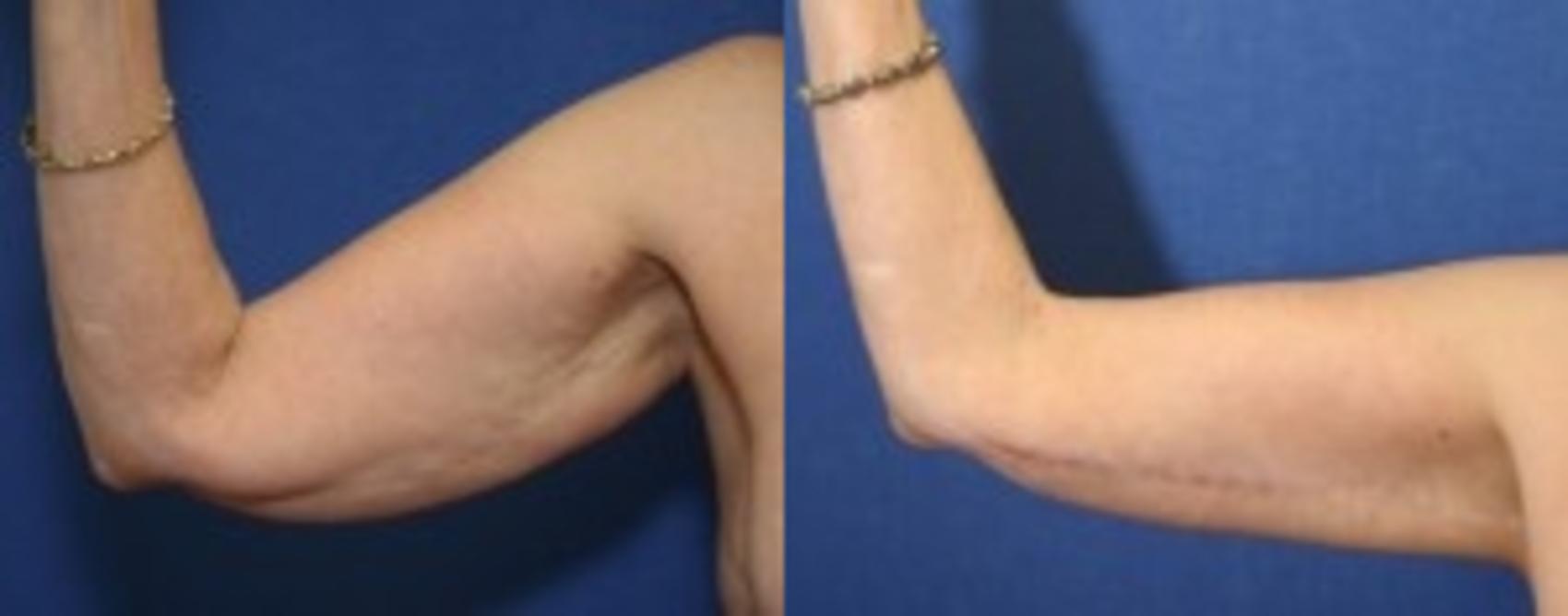 Before & After Upper Arm Lift Case 274 Front View in Ann Arbor, MI