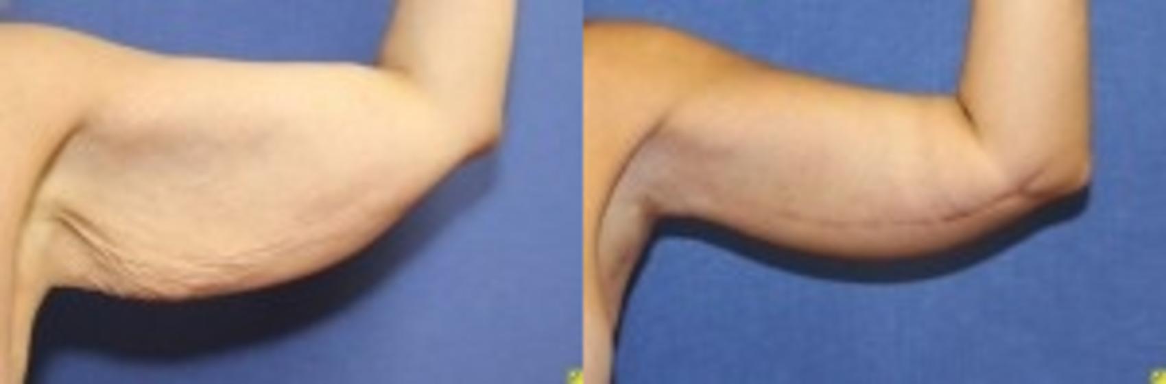 Before & After Upper Arm Lift Case 275 Front View in Ypsilanti, MI