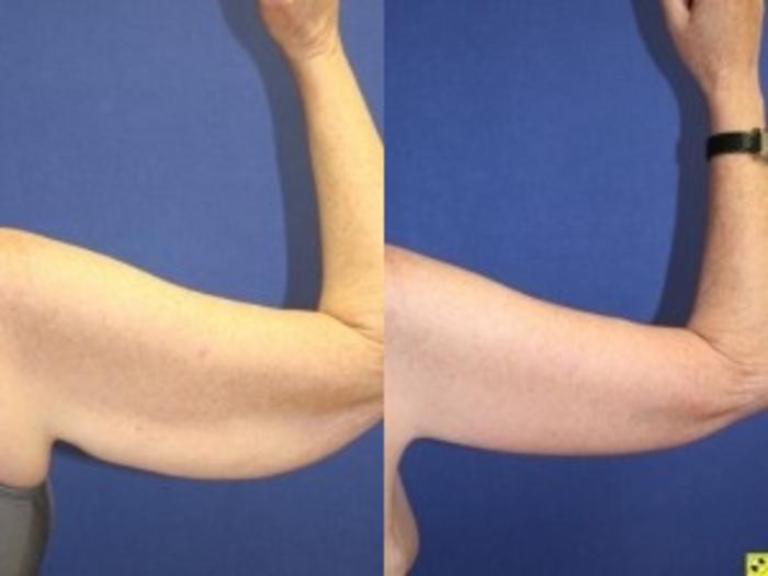 Before & After Upper Arm Lift Case 276 Front View in Ann Arbor, MI