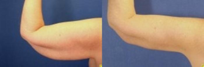 Before & After Upper Arm Lift Case 277 Front View in Ypsilanti, MI