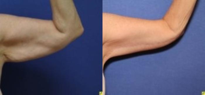 Before & After Upper Arm Lift Case 278 Front View in Ann Arbor, MI