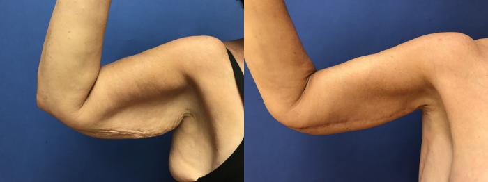 Before & After Upper Arm Lift Case 279 Front View in Ypsilanti, MI