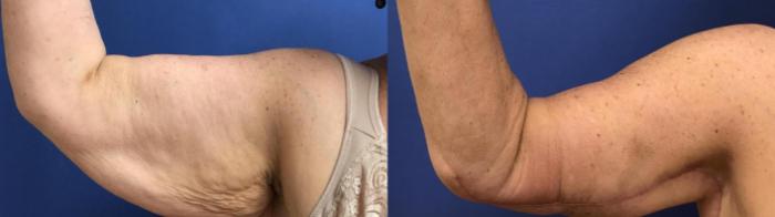 Before & After Upper Arm Lift Case 280 Front View in Ann Arbor, MI
